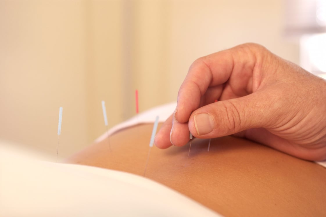 Hand placing acupuncture needles